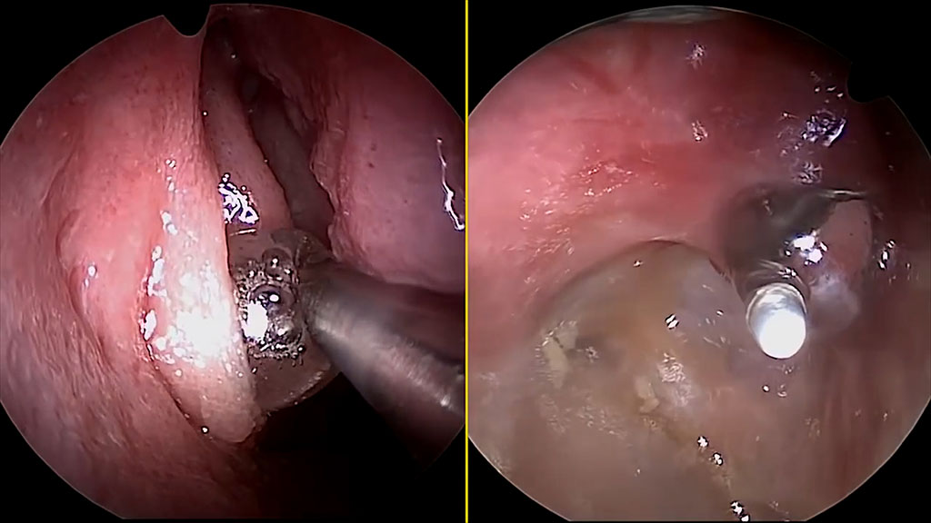 Balloon sinus dilation internal technical image