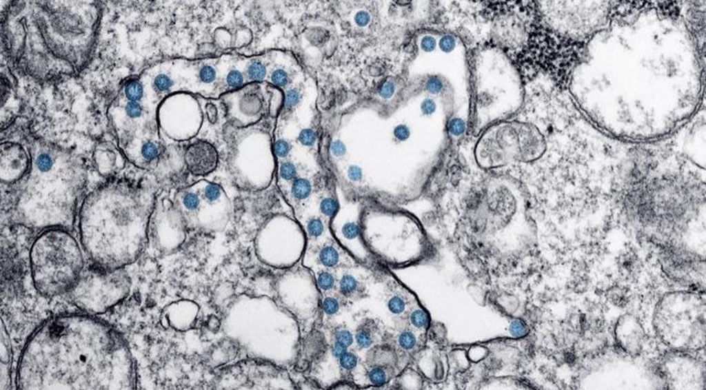 virus Coronavirus as seen through a microscope.